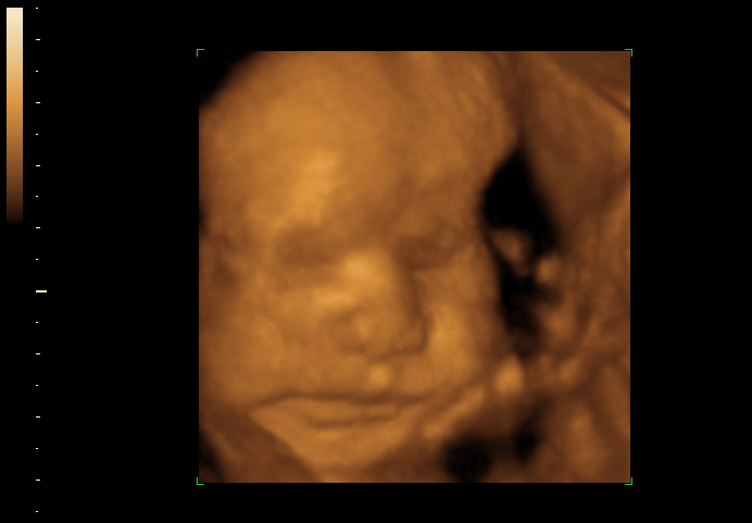 3D ultrasound image at 25 weeks
